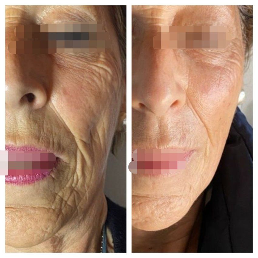 antes y dp edna edicion especial