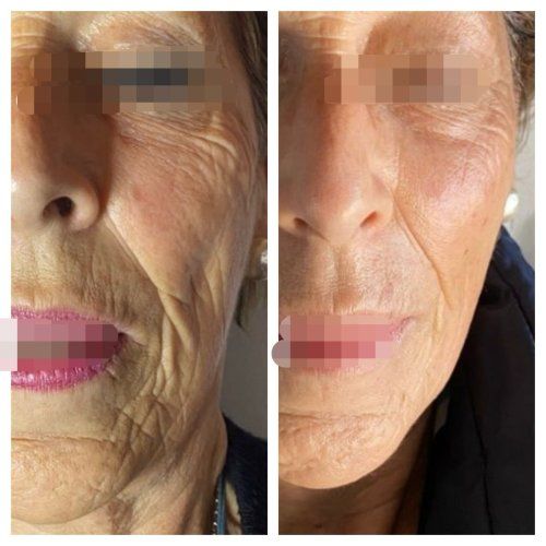 antes y dp edna edicion especial