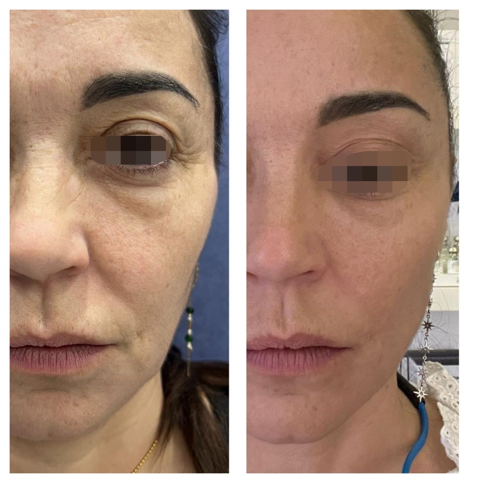 reverso antes y dp de 3 sesiones